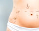 tummy_tucks_body_lifts_abdominoplasty